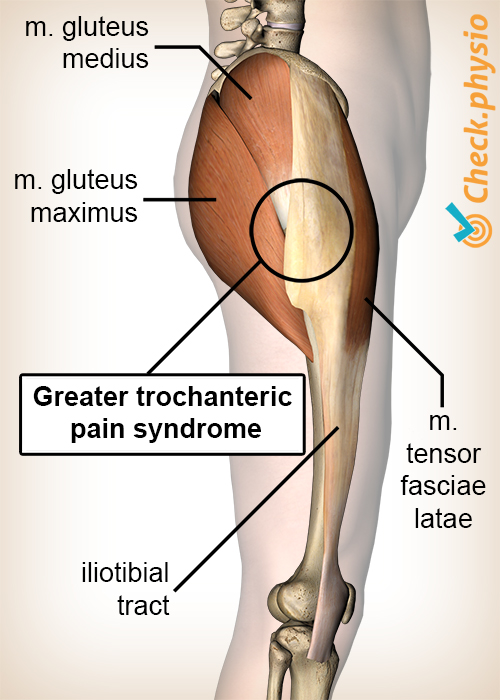 hip greater trochanter pain syndrome anatomy