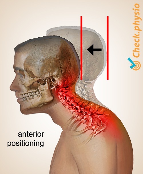 head neck cervical posture syndrome forward carriage anteroposition