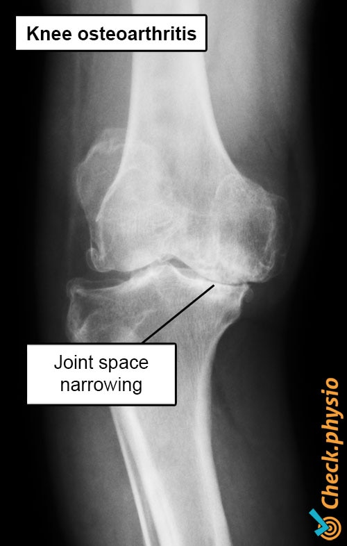 knee osteoarthritis x-ray