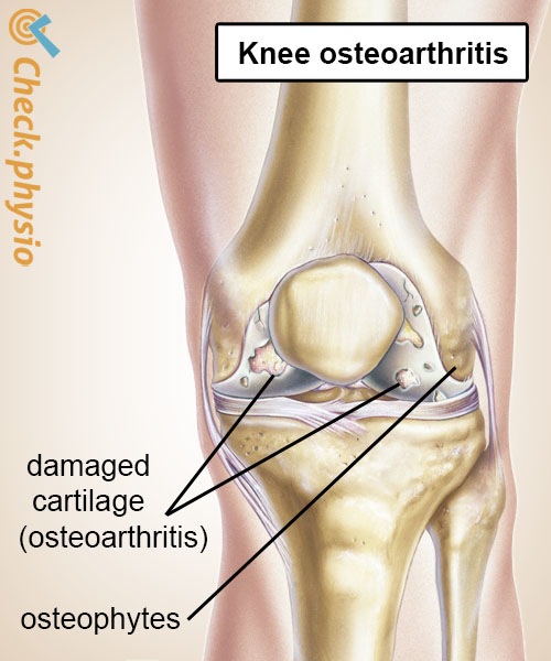 knee osteoarthritis cartilage degeneration