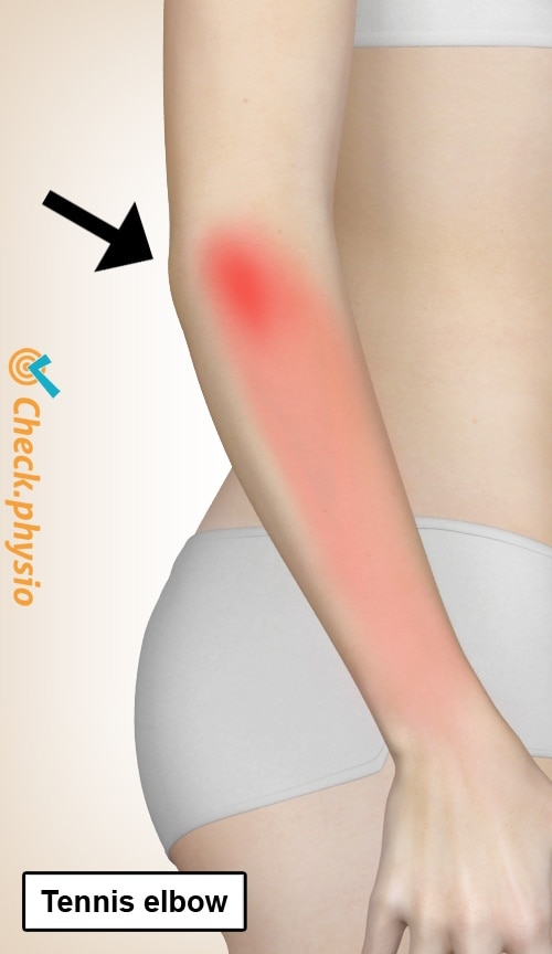 arm tennis elbow location