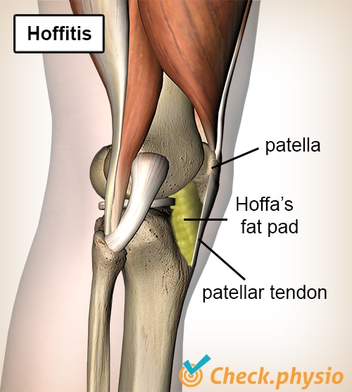 knee hoffas fat pad hoffitis