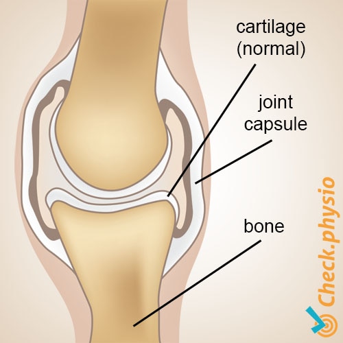 Osteoarthritis