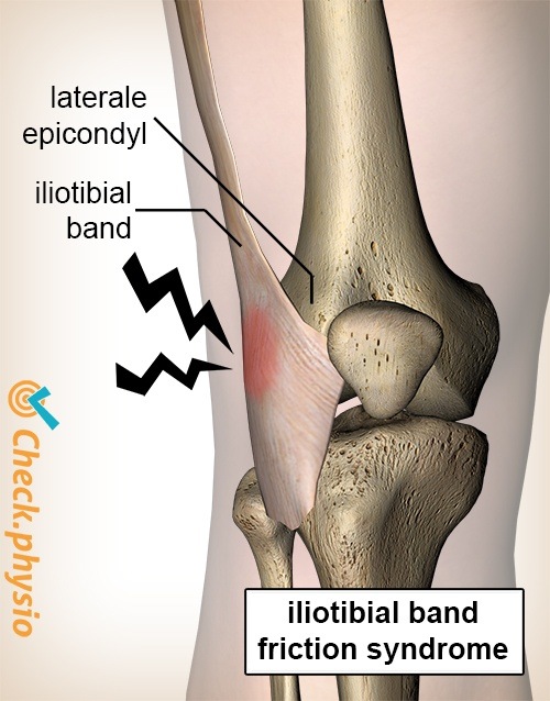 knee iliotibial band syndrome lateral epicondyle