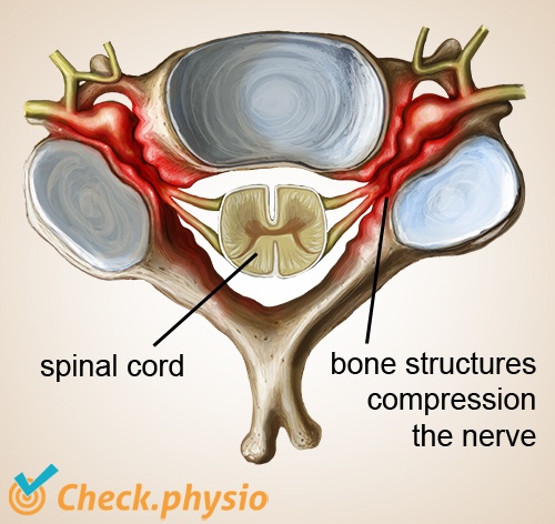 neck cervical radiculopathy stenosis hard hernia