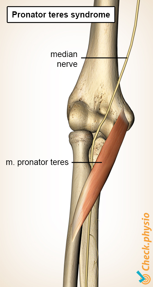 forearm pronator teres muscle median nerve syndrome
