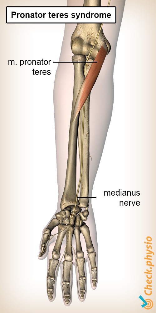 forearm pronator teres syndrome muscle median nerve