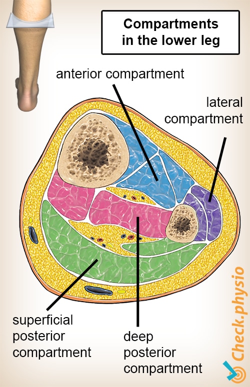 Compartment syndrome of the lower leg