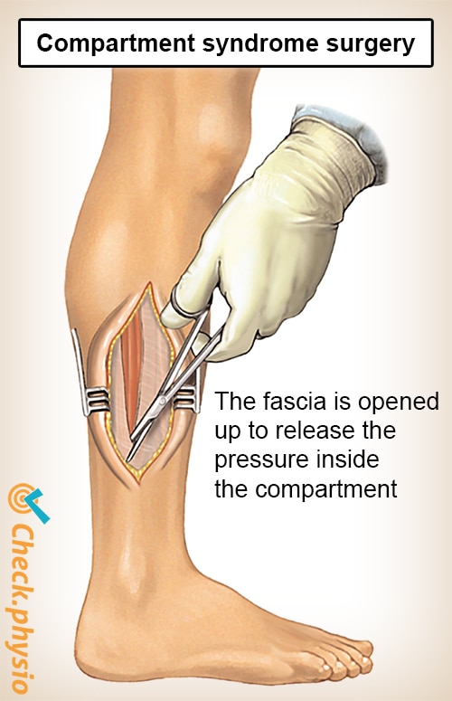 Compartment syndrome of the lower leg