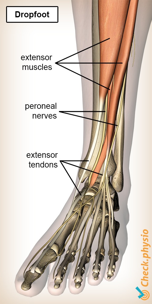 lower leg foot drop peroneal nerves foot extensors muscles tendons