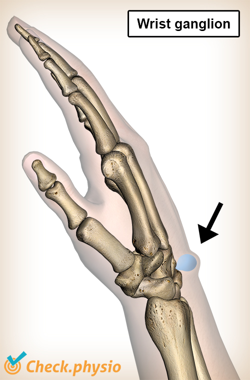 wrist ganglion swelling lump anatomy mucoid cyst