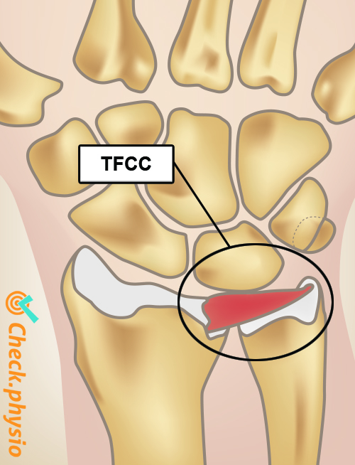 Tfcc Injury Physio Check