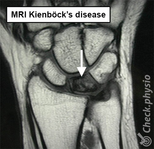 wrist kienbocks disease mri lunate bone