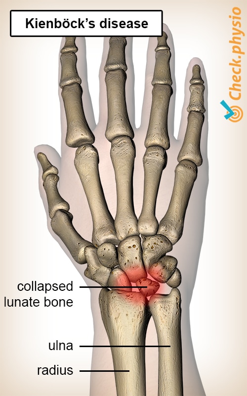 wrist Kienbocks disease lunate moon shaped carpal bone