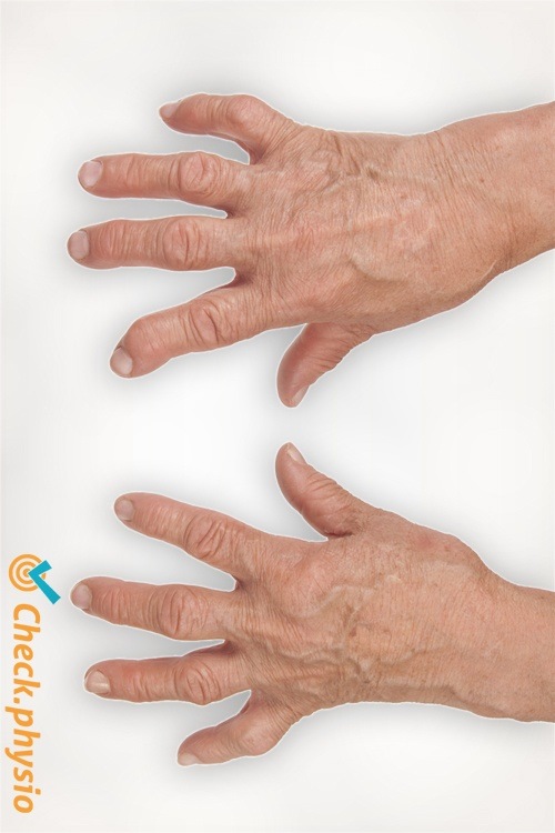 rheumatoid arthritis fingers