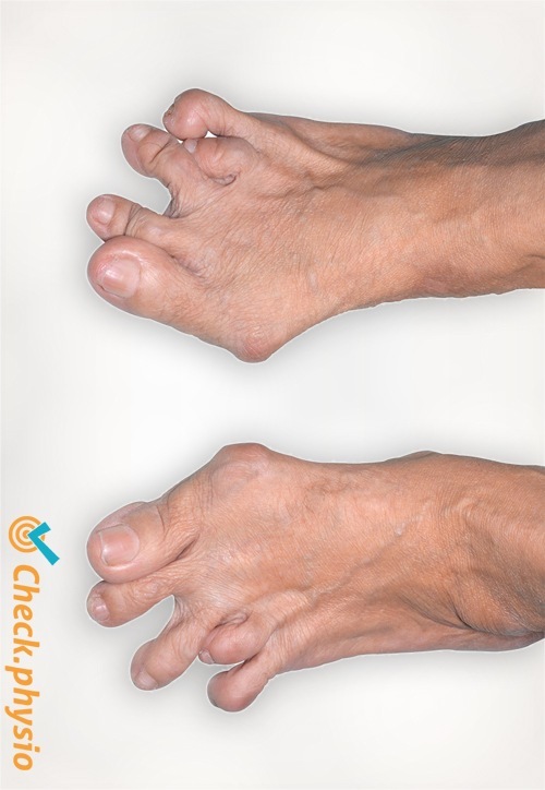 rheumatoid arthritis feet