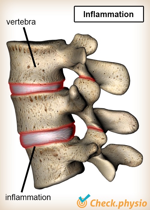 back bechterew vertebrae inflammation