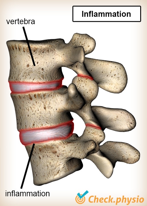 back Bechterew vertebrae inflammation