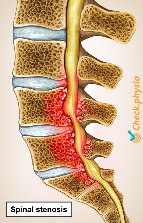 Lumbar spinal stenosis