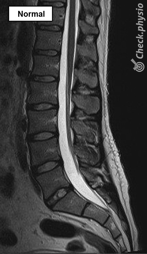 Lumbar spinal stenosis