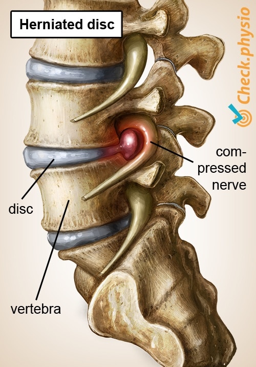 Low Back Pain - Physiopedia