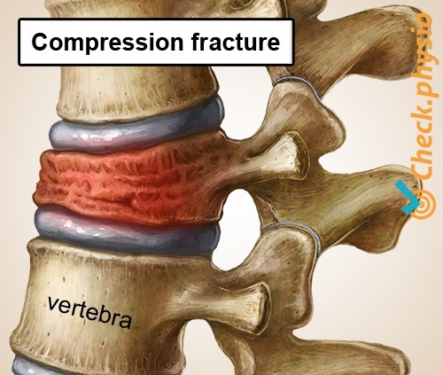 back specific low back pain collapsed vertebra