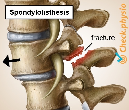 Specific lower back pain