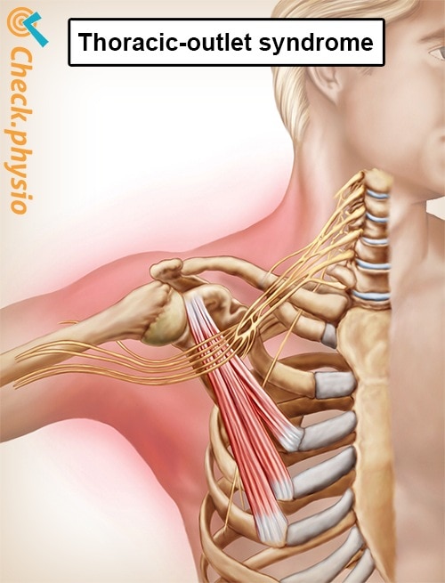 Thoracic Outlet Syndrome