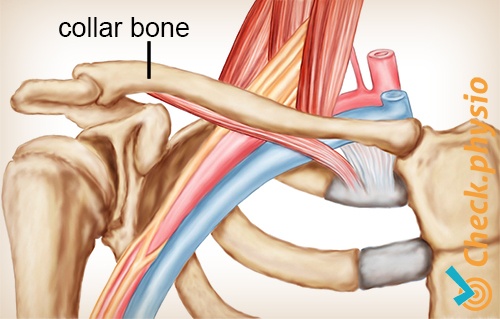 shoulder arm hand TOS thoracic outlet syndrome clavicula collar bone