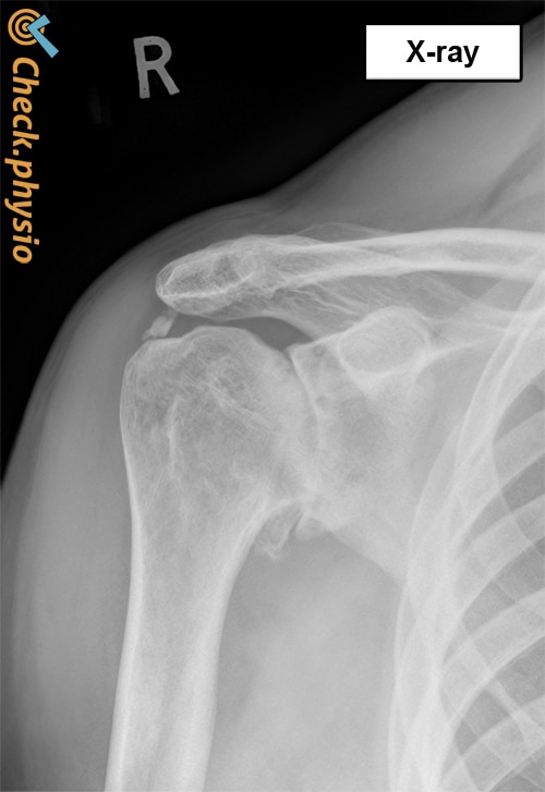 Osteoarthritis of the shoulder | Physio Check