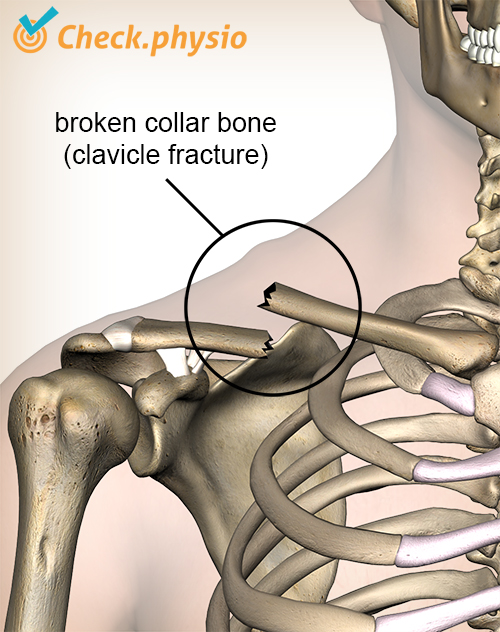 shoulder clavicula fracture broken collar bone break
