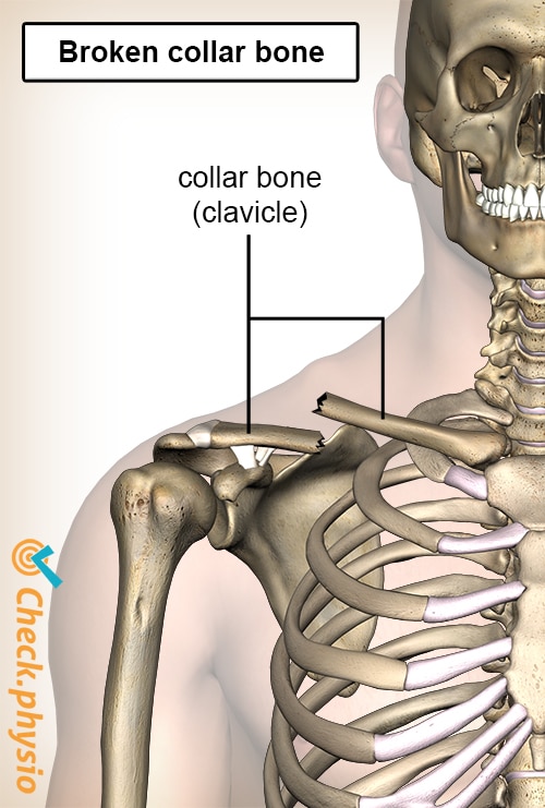 clavicle bone fracture