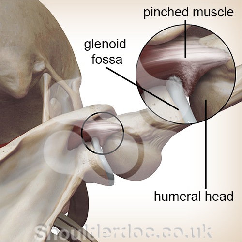 shoulder internal impingement humeral head glenoid fossa socket labrum