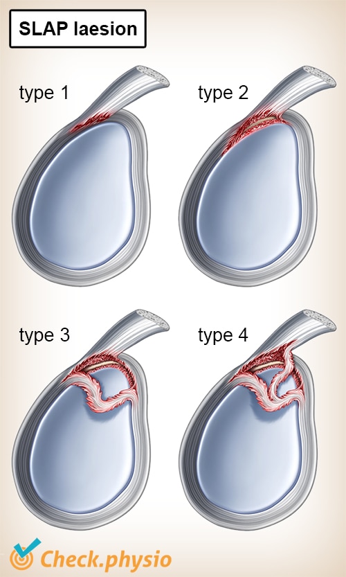 shoulder SLAP lesion types 1 2 3 4