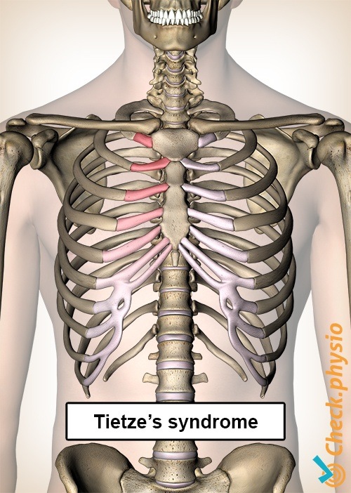 tietzes syndrome ribs rib-cage pain chest sternum