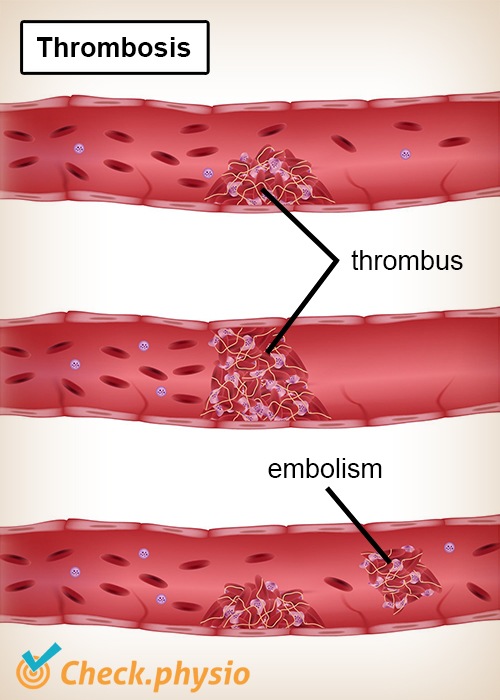 thrombosis thrombus embolism artery vein blood vessel