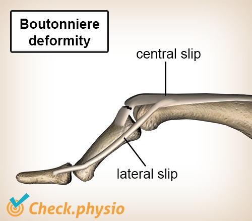 finger boutonniere deformity extensor tendon lateral slip central slip