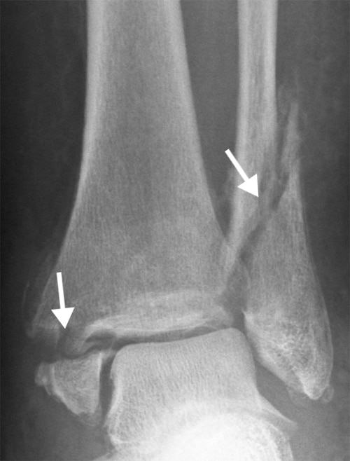 fractured ankle x ray