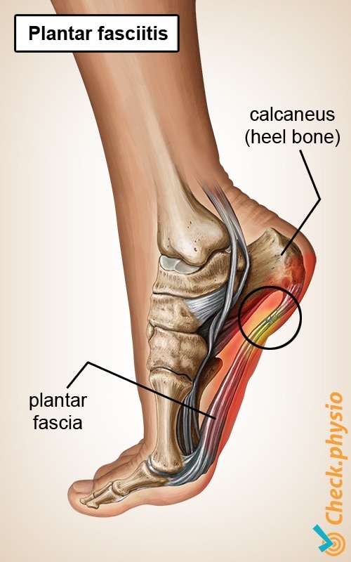 foot plantar fascitis aponeurosis heel spur