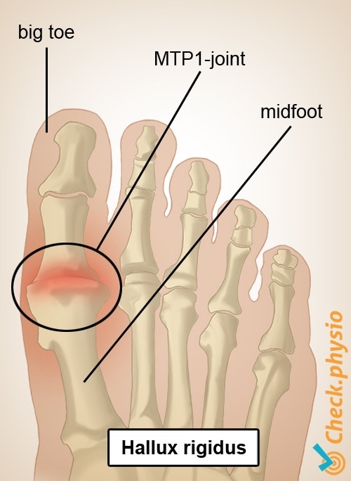 foot hallux rigidus big toe first MTP 1 joint