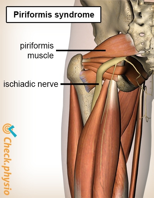 Piriformis Syndrome - Symptoms, Causes & Treatment