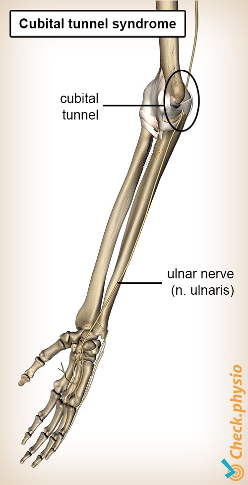 Cubital tunnel syndrome