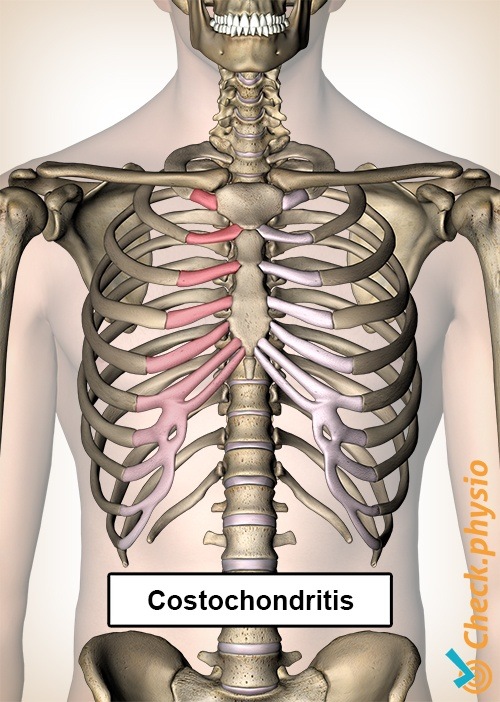 costochondritis ribs pain chest rib-cage sternum