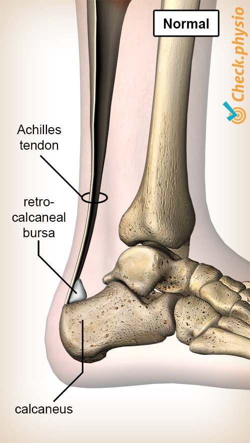 Haglund's Deformity Tysons | Bone Spur | Achilles Tendon Herndon