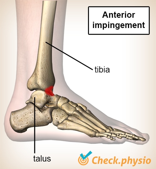 Anterior ankle impingement