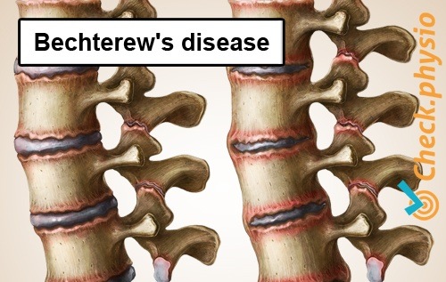 back specific low back pain bechterews disease ankylosing spondylitis