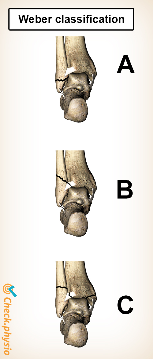 ankle fracture broken weber classification a b c