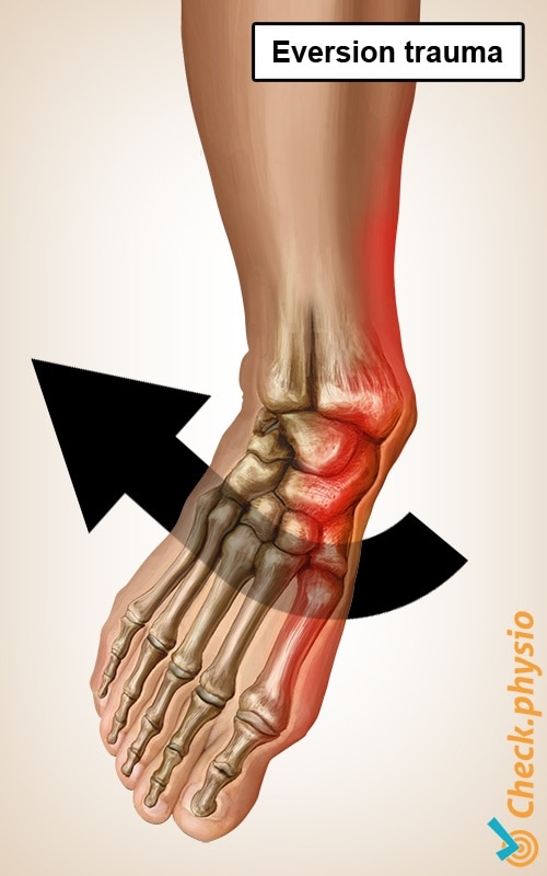 ankle inversion trauma