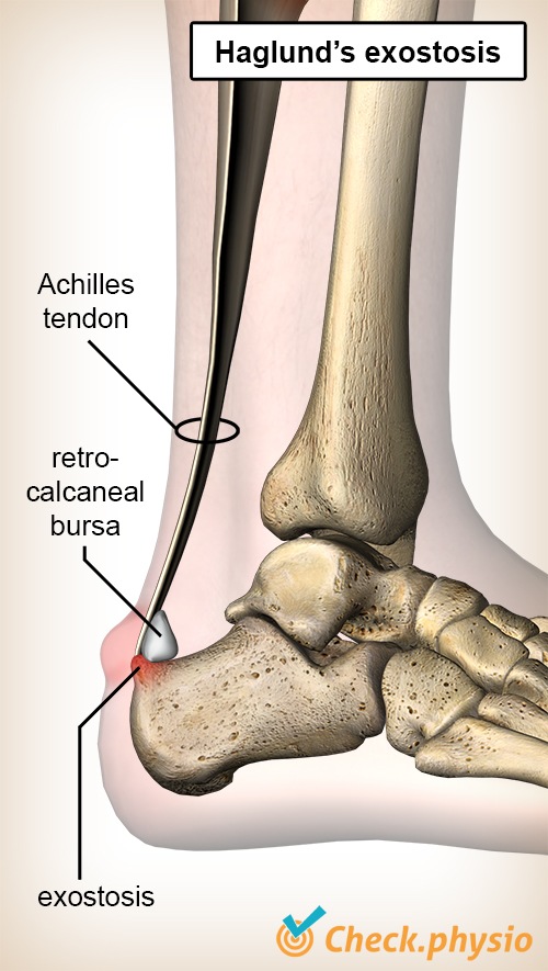 ankle haglunds exostosis deformity achilles tendon retrocalcaneal bursa heel bone calcaneus