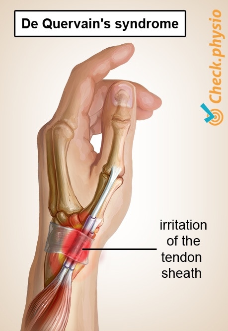 arm de quervains disease